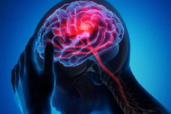 brain stroke